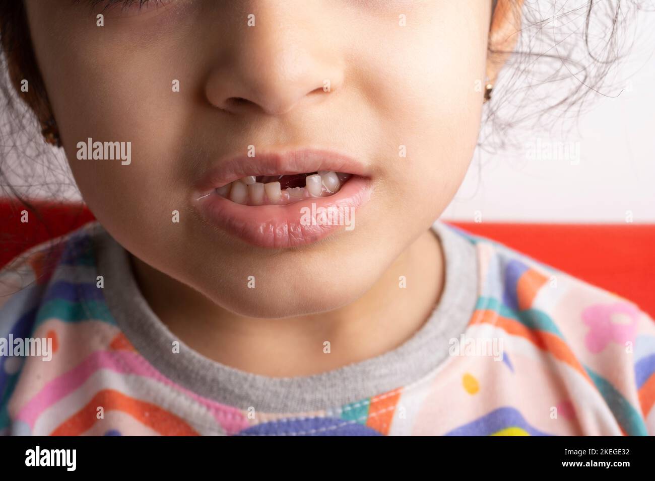 6 Jahre altes kleines Mädchen Porträt mit entfernter Milchzahnstelle - Nahaufnahme Stockfoto