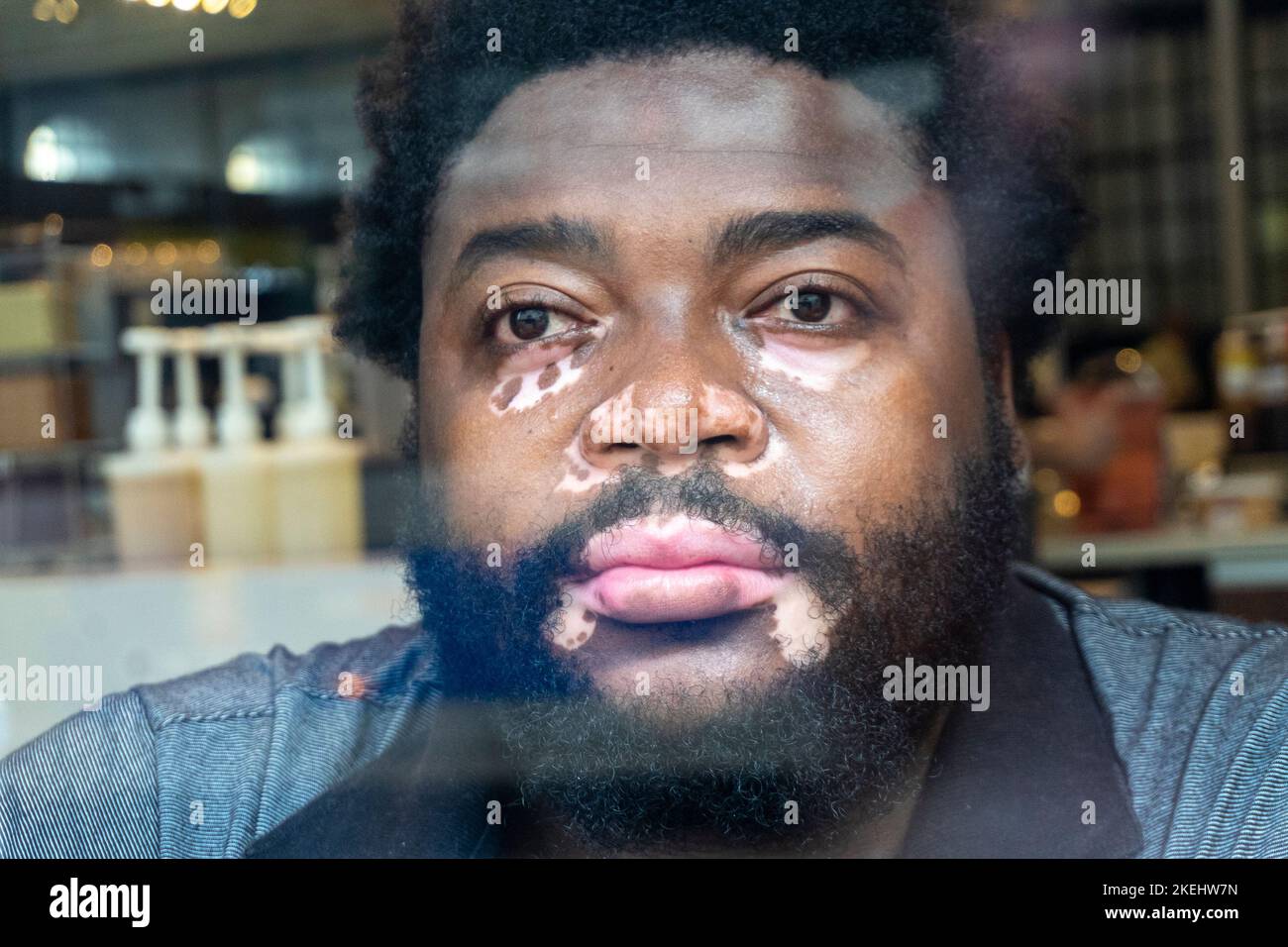 Ein Schwarzer mit Vitiligo benutzt ein Smartphone Stockfoto