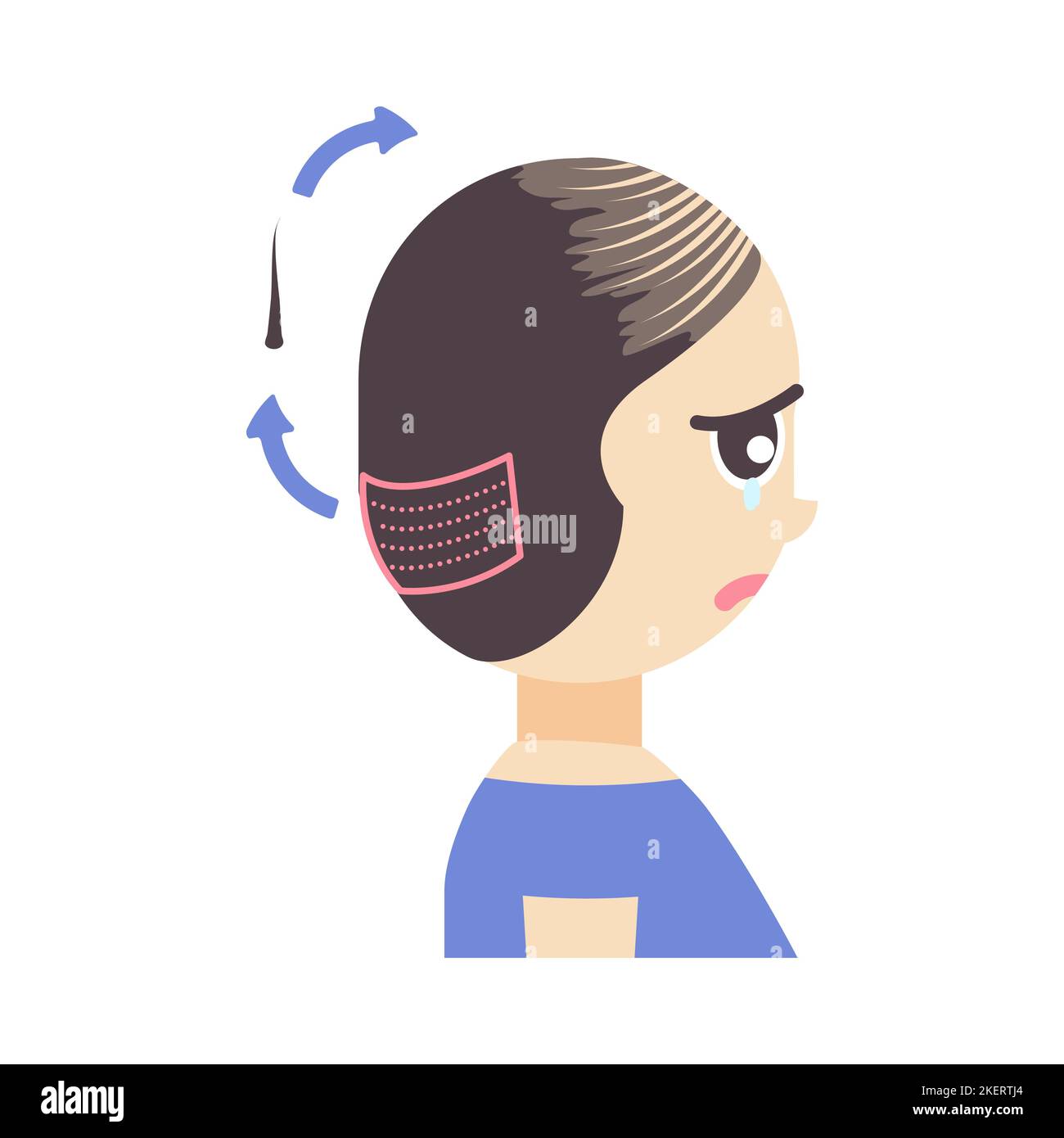 FuE Haartransplantation Behandlung von Alopezie Illustration Stock Vektor