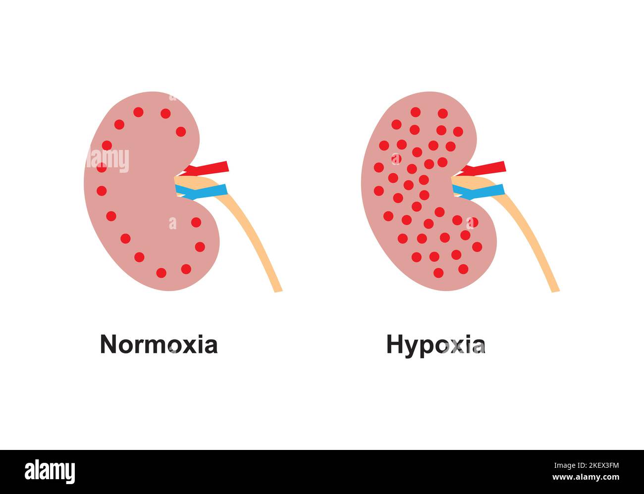 Wissenschaftliche Gestaltung des Vergleichs zwischen Normoxie und Hypoxie. Bunte Symbole. Vektorgrafik. Stock Vektor