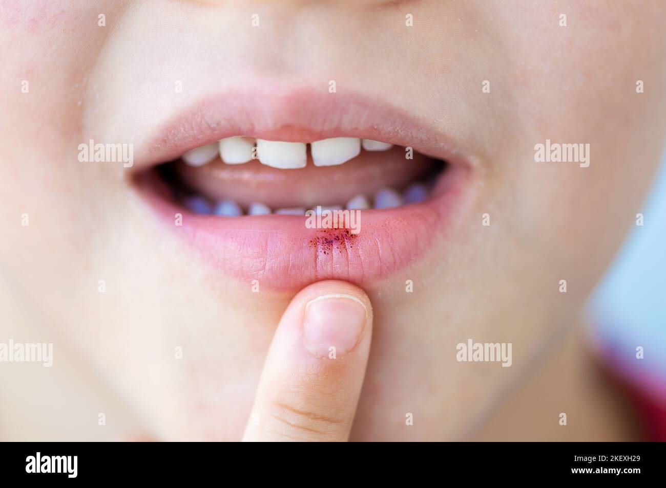 Das Kind hat ein aphtöses Geschwulst oder einen Mundgerippe an der Lippe Stockfoto