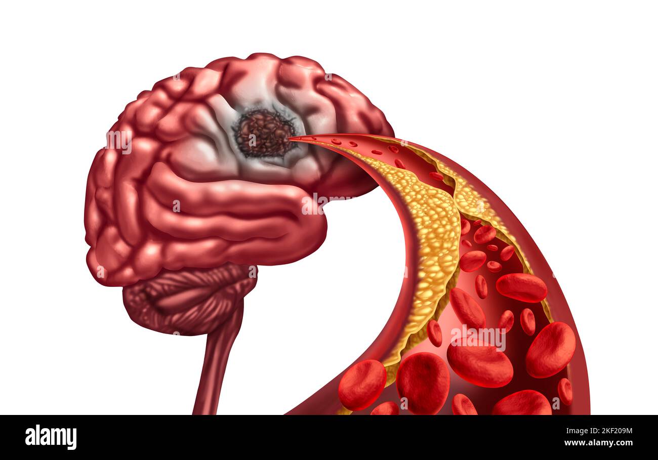 Vaskuläre Demenz und Gehirnliquefaktive Nekrose aufgrund eines Verlustes der Durchblutung des Geistes nach einem Schlaganfall, der durch Arterienblockade verursacht wurde Stockfoto