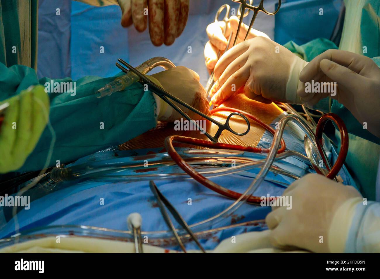 Koronarararterien-Bypass-Transplantat CABG für Herzoperationen aufgrund einer koronaren Herzerkrankung im Operationsraum des Krankenhauses Stockfoto