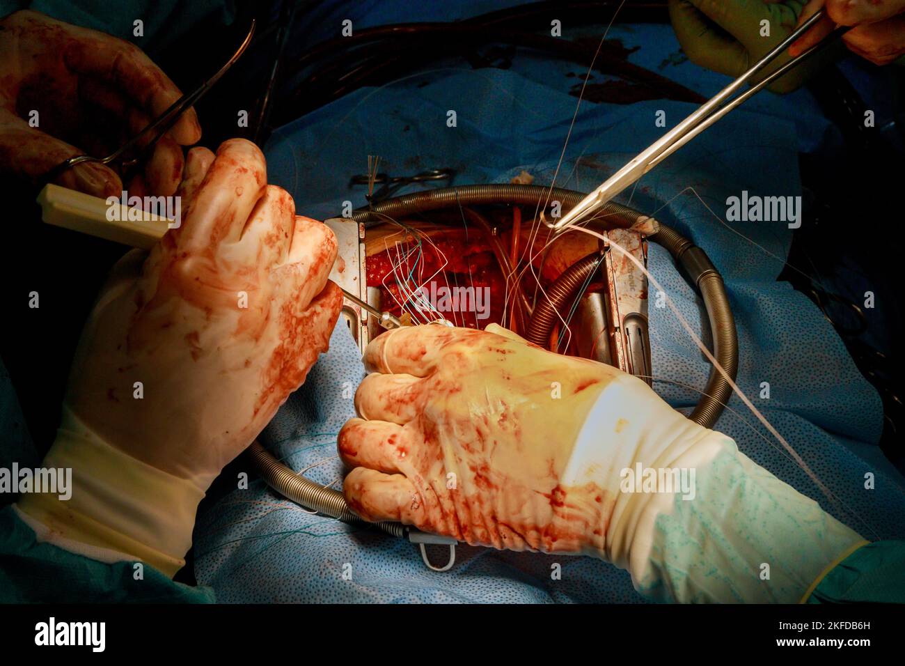 Der Prozess der koronaren Bypass-Transplantation CABG für Herzoperationen aufgrund koronarer Herzkrankheit findet im Operationssaal eines Krankenhauses statt Stockfoto