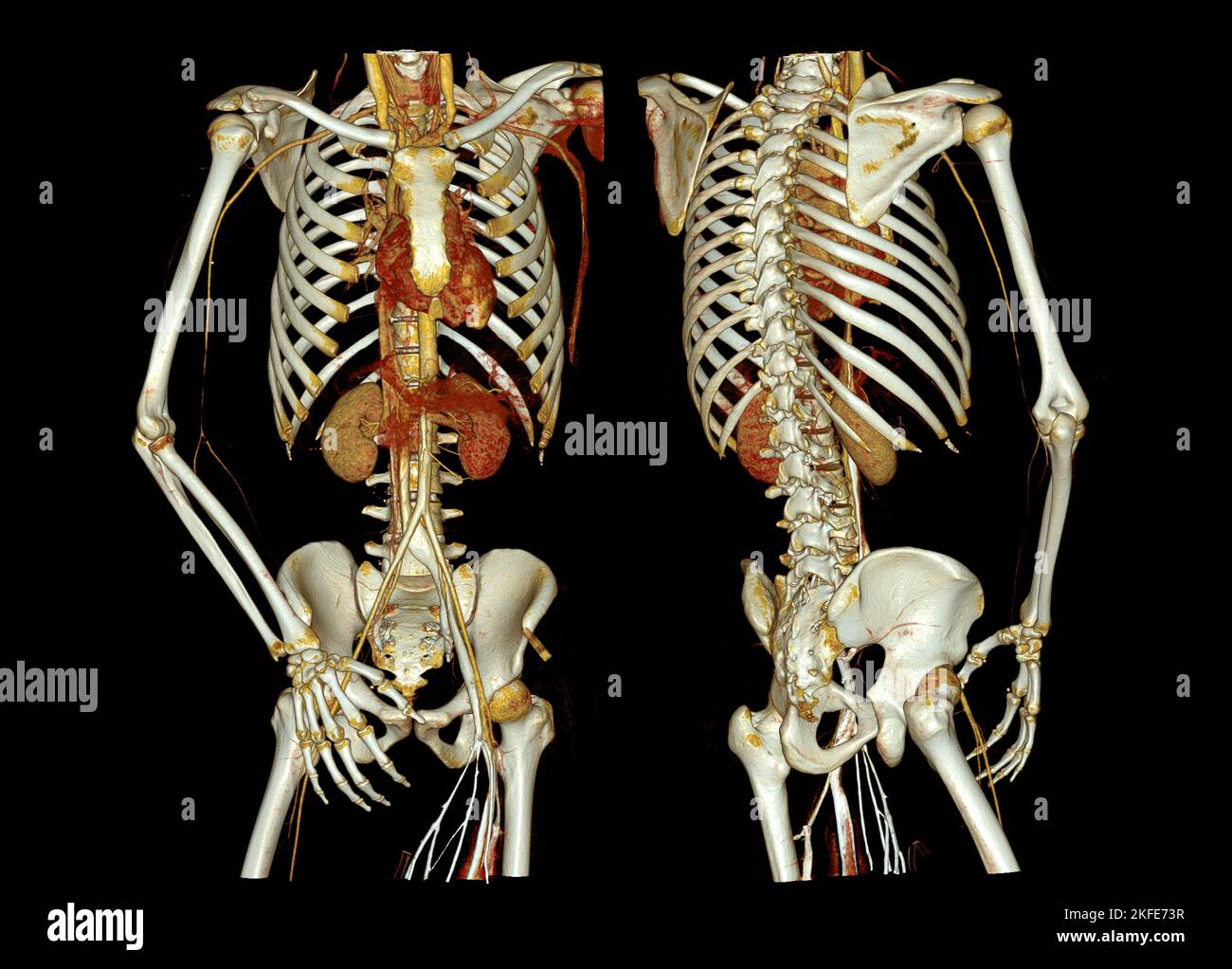 CTA ganze Aorta und Brachialarterie 3D Rendering Bild bei Patienten tramatic. Stockfoto