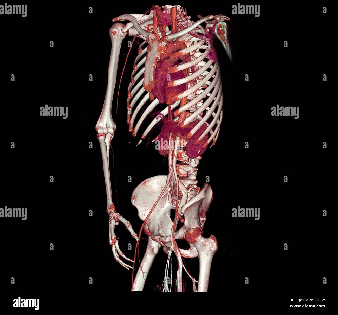 CTA ganze Aorta und Brachialarterie 3D Rendering Bild bei Patienten tramatic. Stockfoto