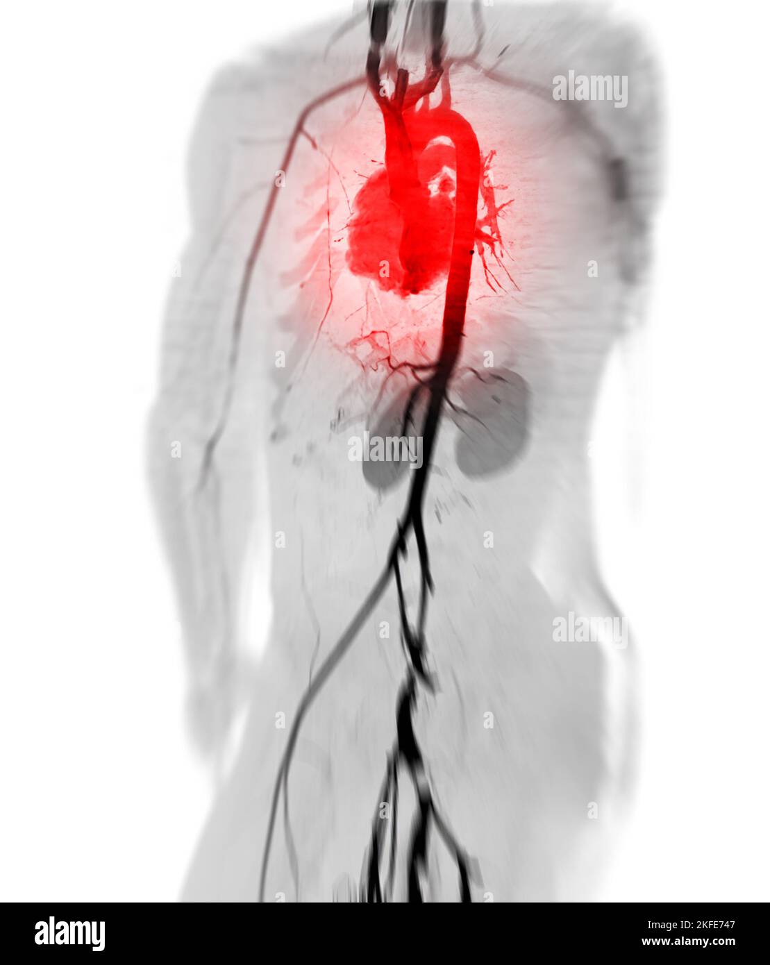 CTA ganze Aorta und Brachialarterie 3D Rendering Bild bei Patienten tramatic. Stockfoto