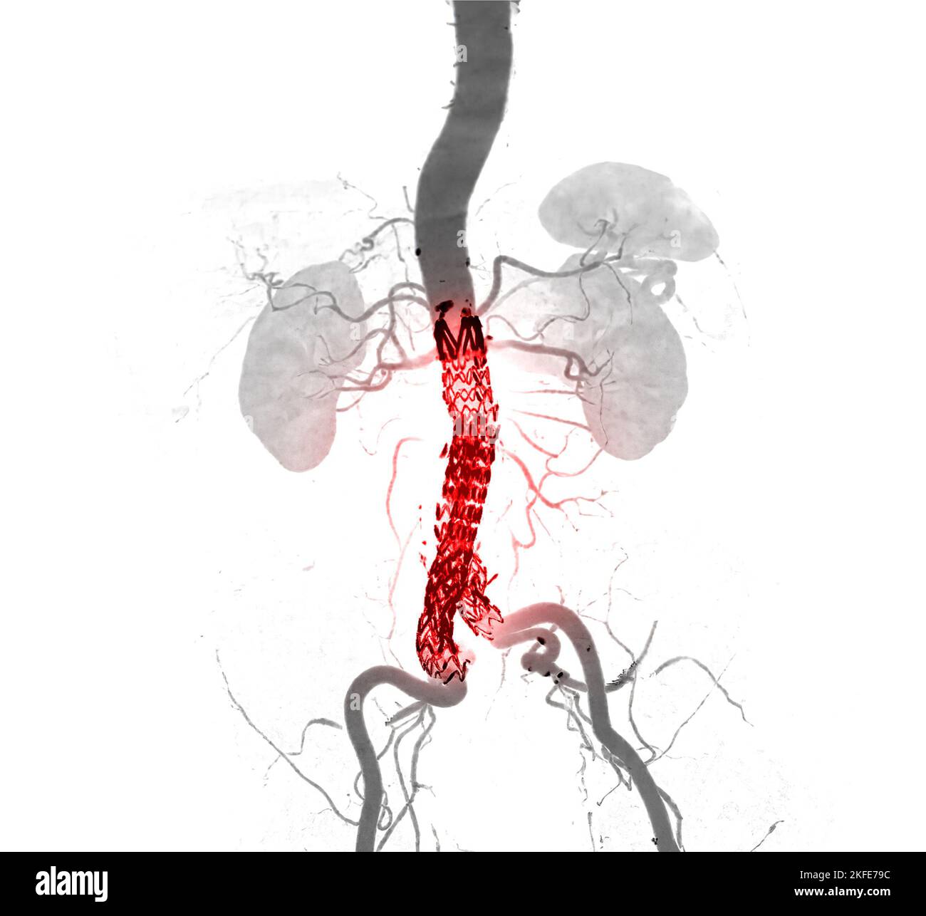CTA-Ganzaorta mit abdominaler Aorta-Stenttransplantation Vergleich des ...