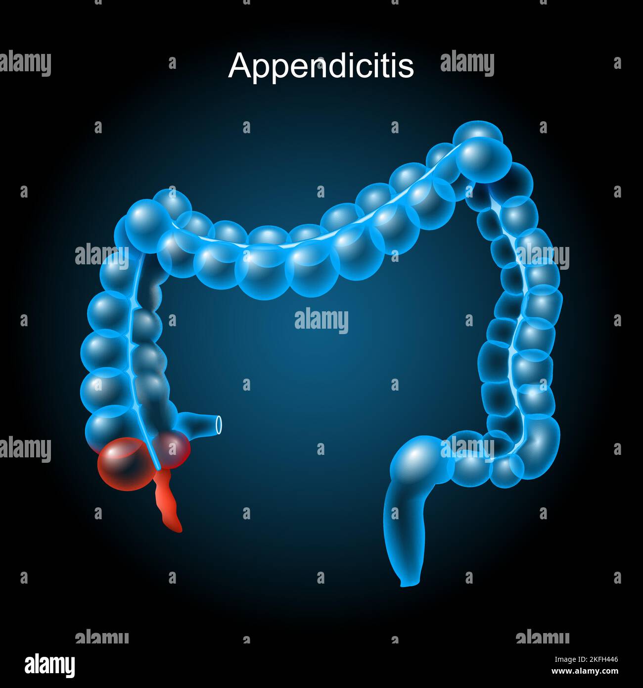 Appendizitis. Entzündung des Blinddarms. Dickdarm auf dunklem Hintergrund. Magen-Darm-Trakt. Verdauungssystem. Anatomie des menschlichen Körpers. Vektor Stock Vektor