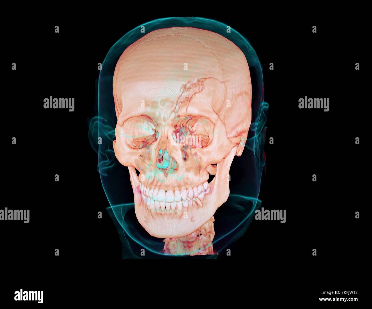 Schädelfraktur, 3D-CT-Scan Stockfoto