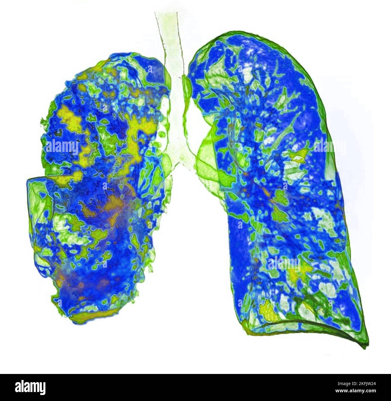 Pneumonie, 3D-CT-Scan Stockfoto