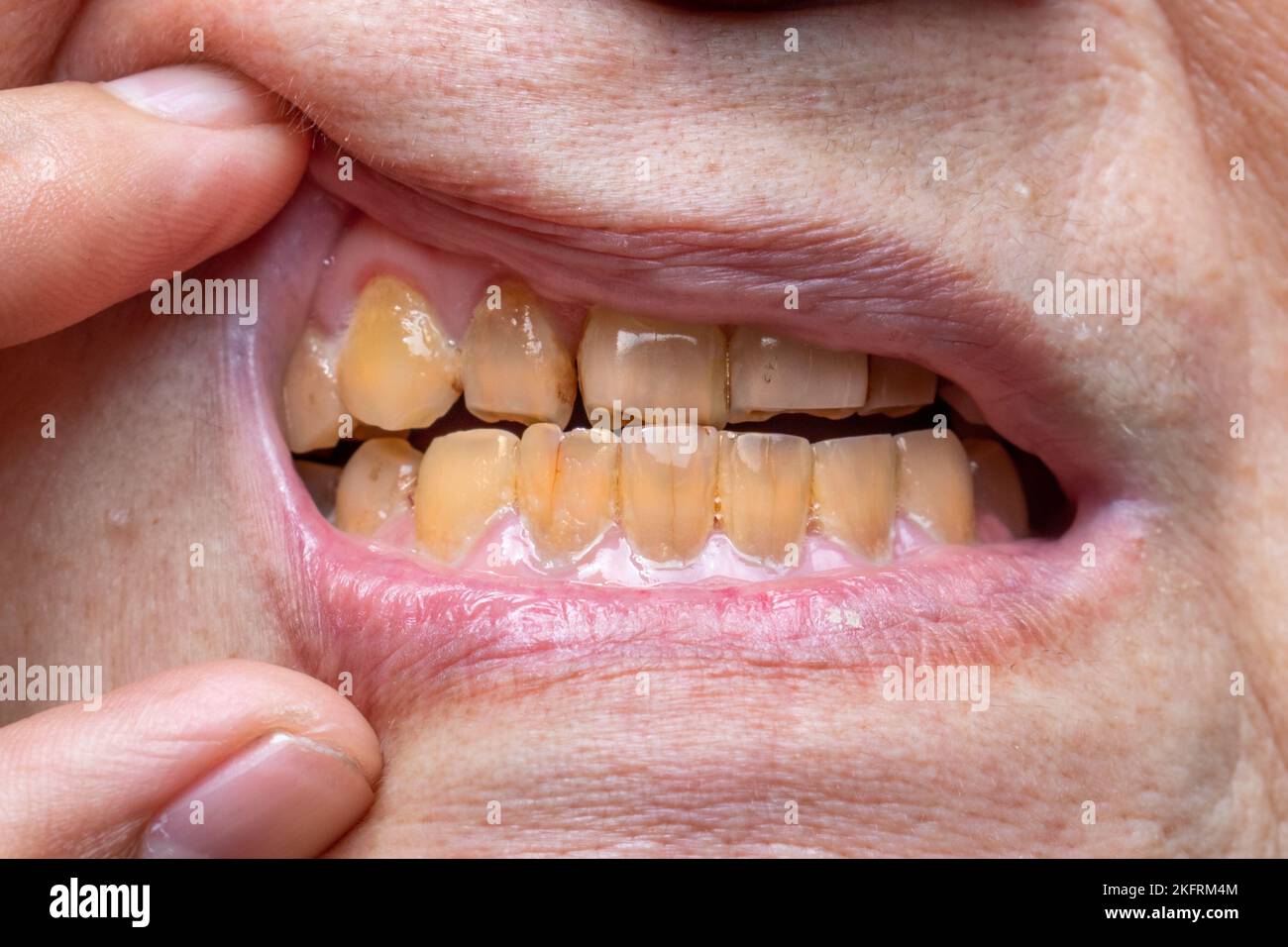 Überfüllte Zähne mit gelb gefärbten Tabakflecken. Schlechte Mundhygiene. Stockfoto