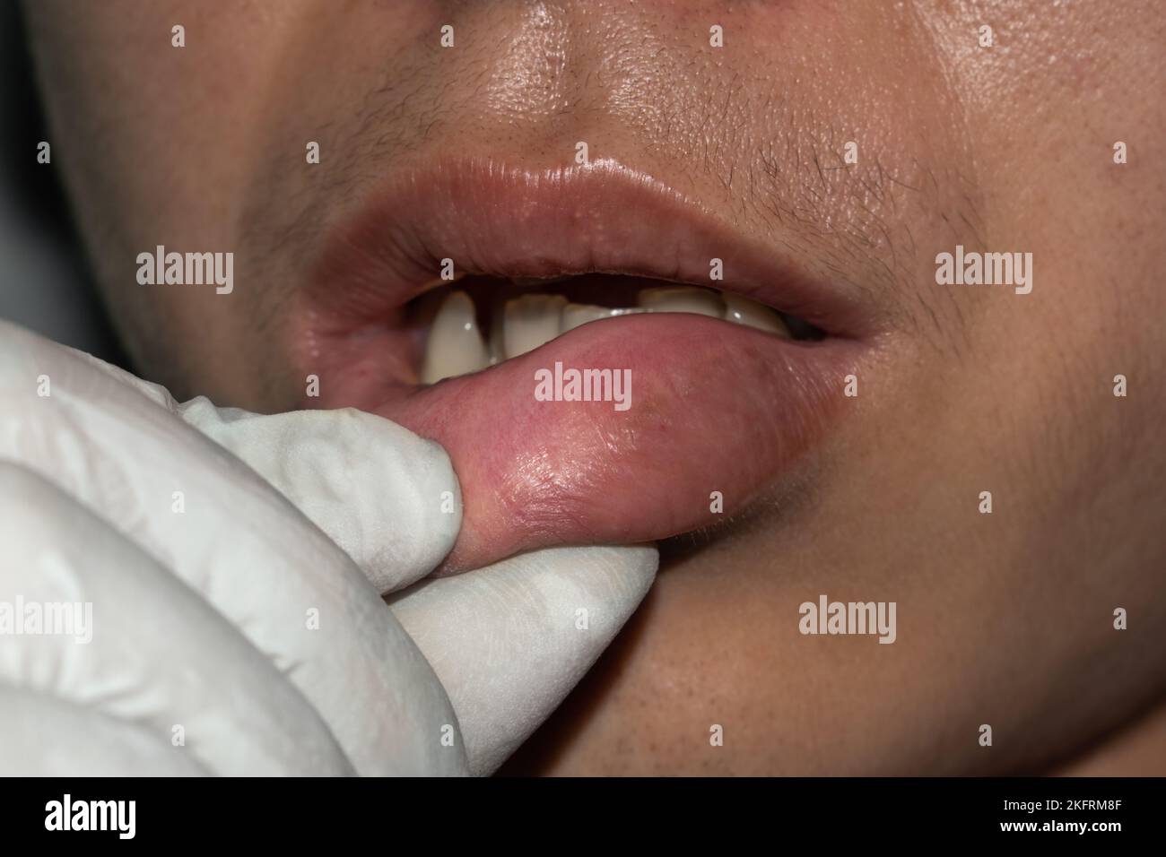 Geschwollene oder verdickte Lippe eines jungen asiatischen Mannes. Angioödem. Ursachen können Allergien, Infektionen, Verletzungen usw. sein Stockfoto