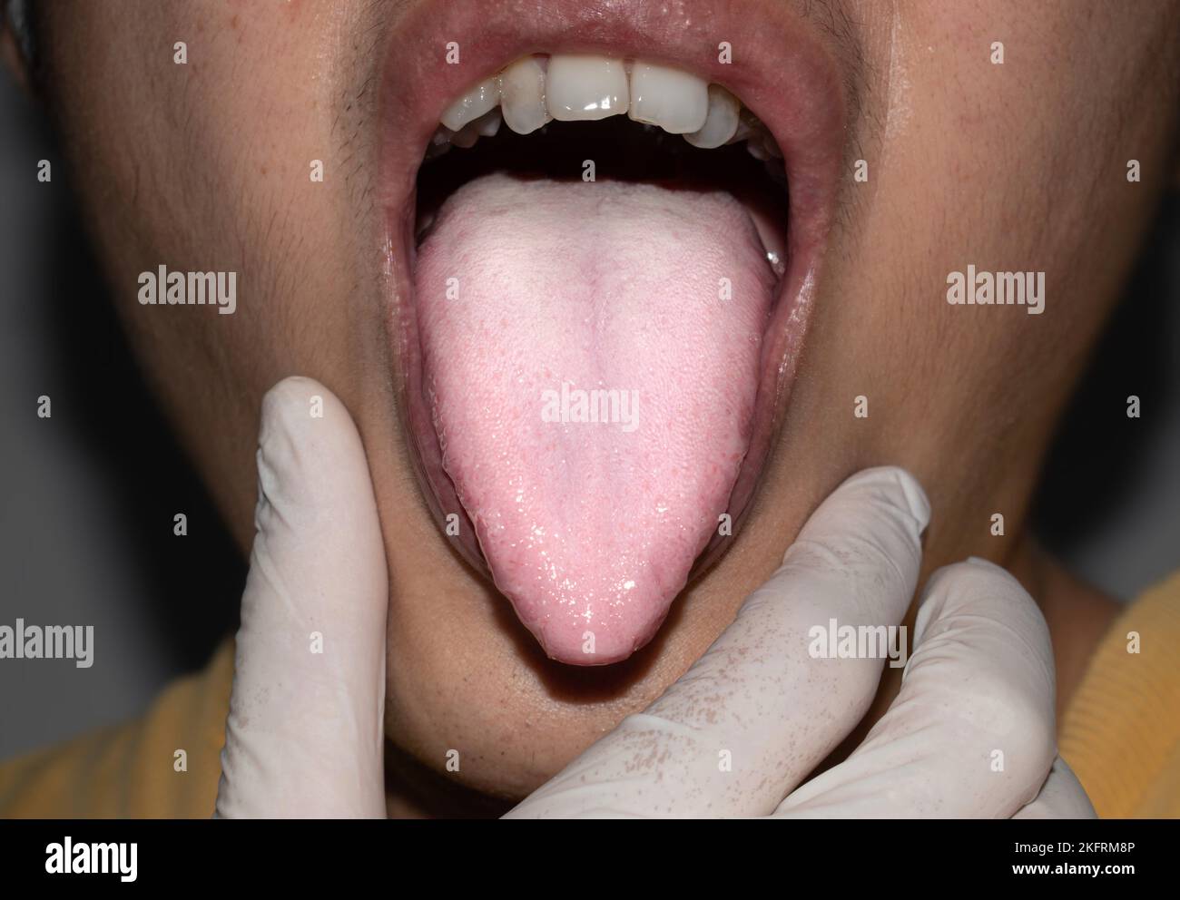 Beschichtete Zunge oder weiße Zunge eines asiatischen, chinesischen Mannes. Es erscheint mit einer weißen Schicht, wenn sich Rückstände, Bakterien und abgestorbene Zellen zwischen vergrößertem p absetzen Stockfoto