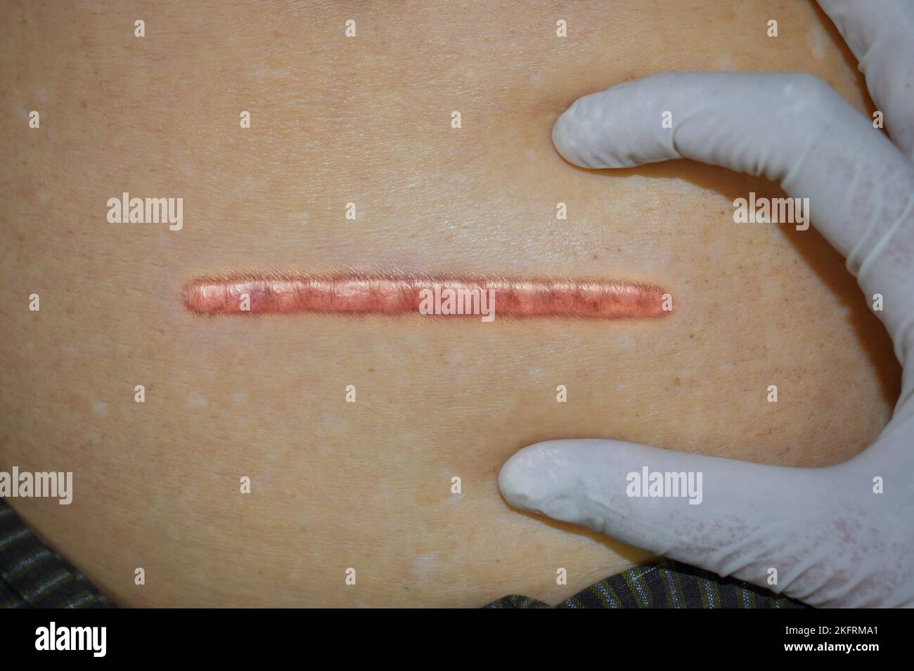 Ordentlich, ordentlich und sauber Keloid Narbe. Gerader chirurgischer Schnitt. Draufsicht. Stockfoto