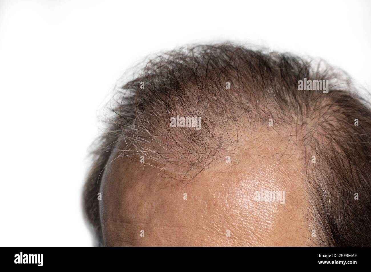 Kahler Kopf des älteren Mannes aus Asien. Konzept der männlichen Haarausfall oder spärliches Haar. Stockfoto