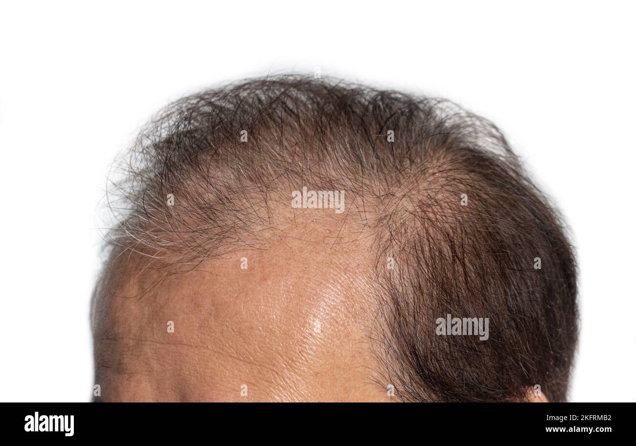 Kahler Kopf des älteren Mannes aus Asien. Konzept der männlichen Haarausfall oder spärliches Haar. Stockfoto