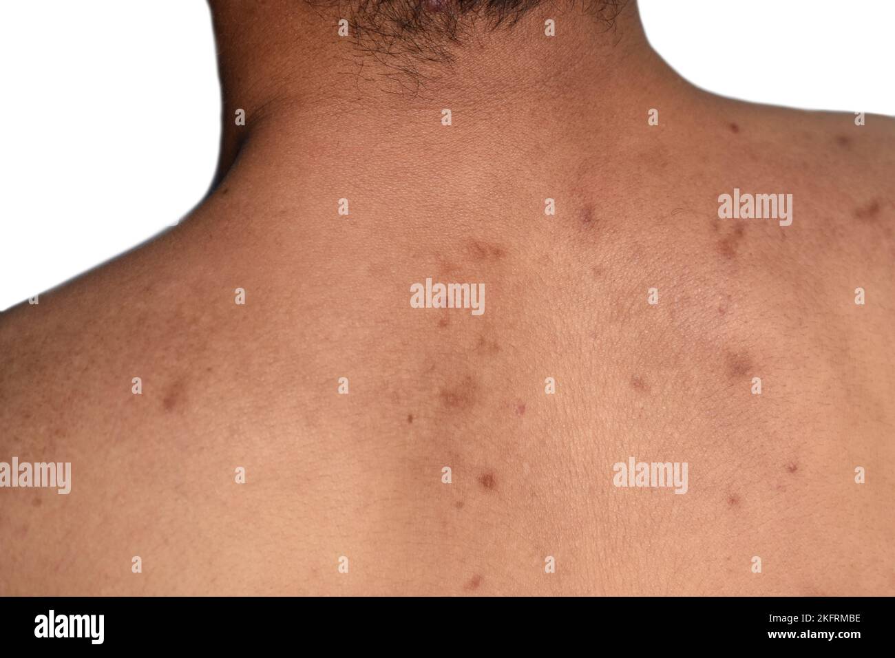 Schwarze Flecken und Narben auf dem Rücken des asiatischen Mannes aus Myanmar Stockfoto