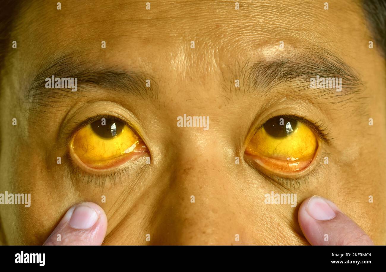 Tiefer Gelbsucht bei einem asiatischen männlichen Patienten. Gelbliche Verfärbung von Haut und Sklera. Hyperbilirubinämie. Akute Hepatitis. Stockfoto