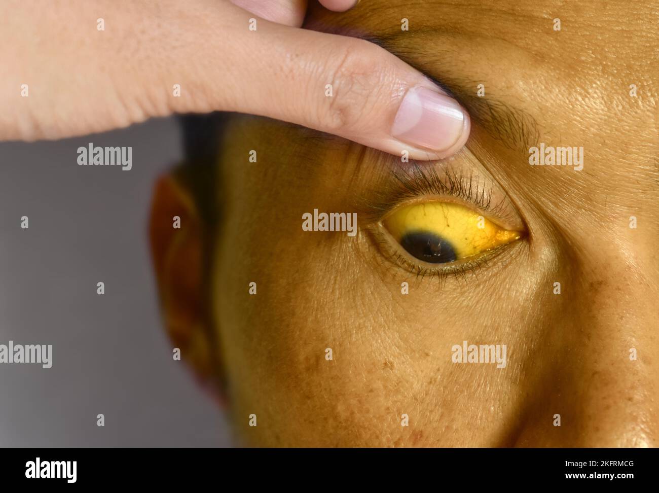 Tiefer Gelbsucht bei einem asiatischen männlichen Patienten. Gelbliche Verfärbung von Haut und Sklera. Hyperbilirubinämie. Akute Hepatitis. Stockfoto