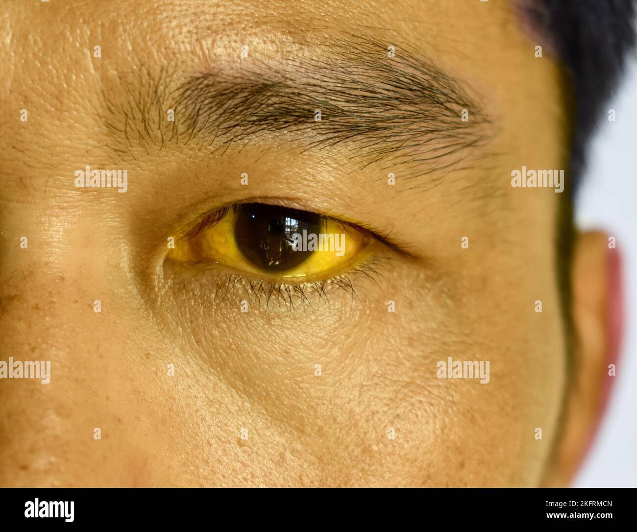 Tiefer Gelbsucht bei einem asiatischen männlichen Patienten. Gelbliche Verfärbung von Haut und Sklera. Hyperbilirubinämie. Akute Hepatitis. Stockfoto