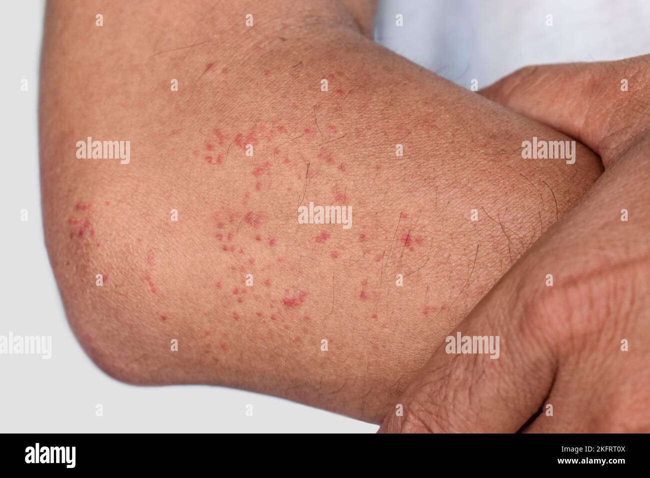 Mehrere juckende Moskitos oder Insektenbiss-Keuchen; rote Flecken auf dem Unterarm des erwachsenen Mannes aus Südostasien. Stockfoto