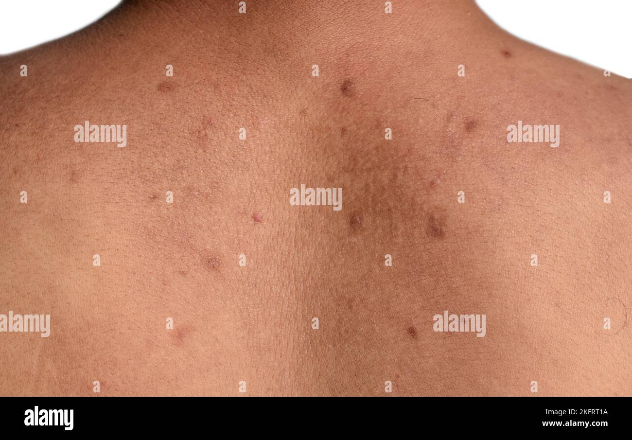 Schwarze Flecken und Narben auf dem Rücken des asiatischen Mannes aus Myanmar Stockfoto