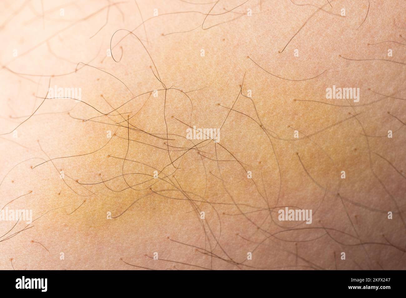 Verletzte menschliche Haut mit Prellung Makro Nahaufnahme Stockfoto