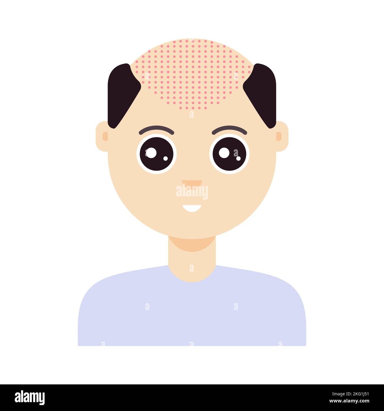 FuE Haartransplantation Behandlung von Alopezie Stock Vektor