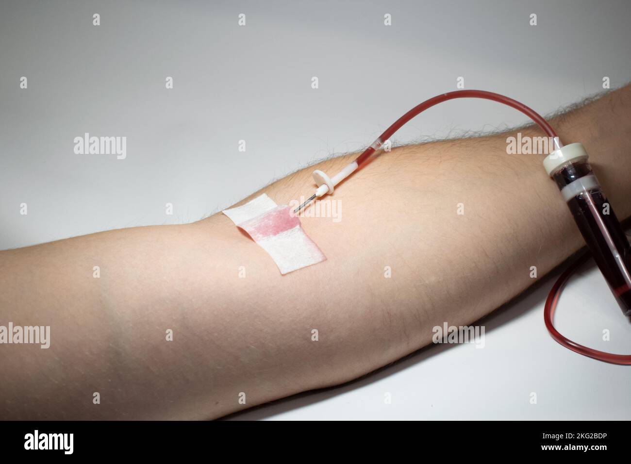 Der Prozess der Bluttransfusion oder Blutspende aus einer Vene im Arm Stockfoto