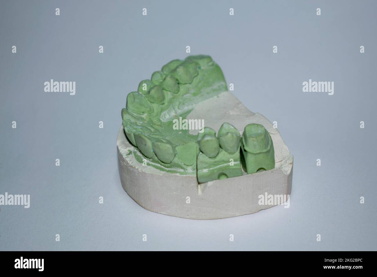 Gipsabdrücke der Zähne des Unterkiefers für Prothetik und Implantation in der Zahnmedizin. Stockfoto