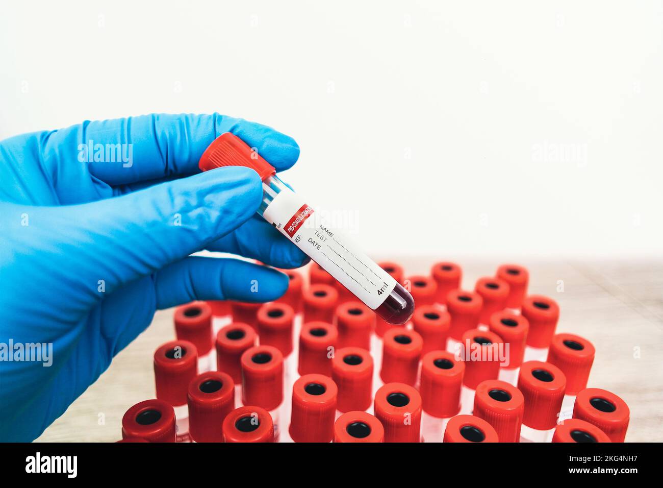 Ein Bluttest Probenröhrchen mit rotem Verschluss befindet sich in der Hand eines blau behandelten Arztes, Hämatologie-Labor-Konzept Stockfoto