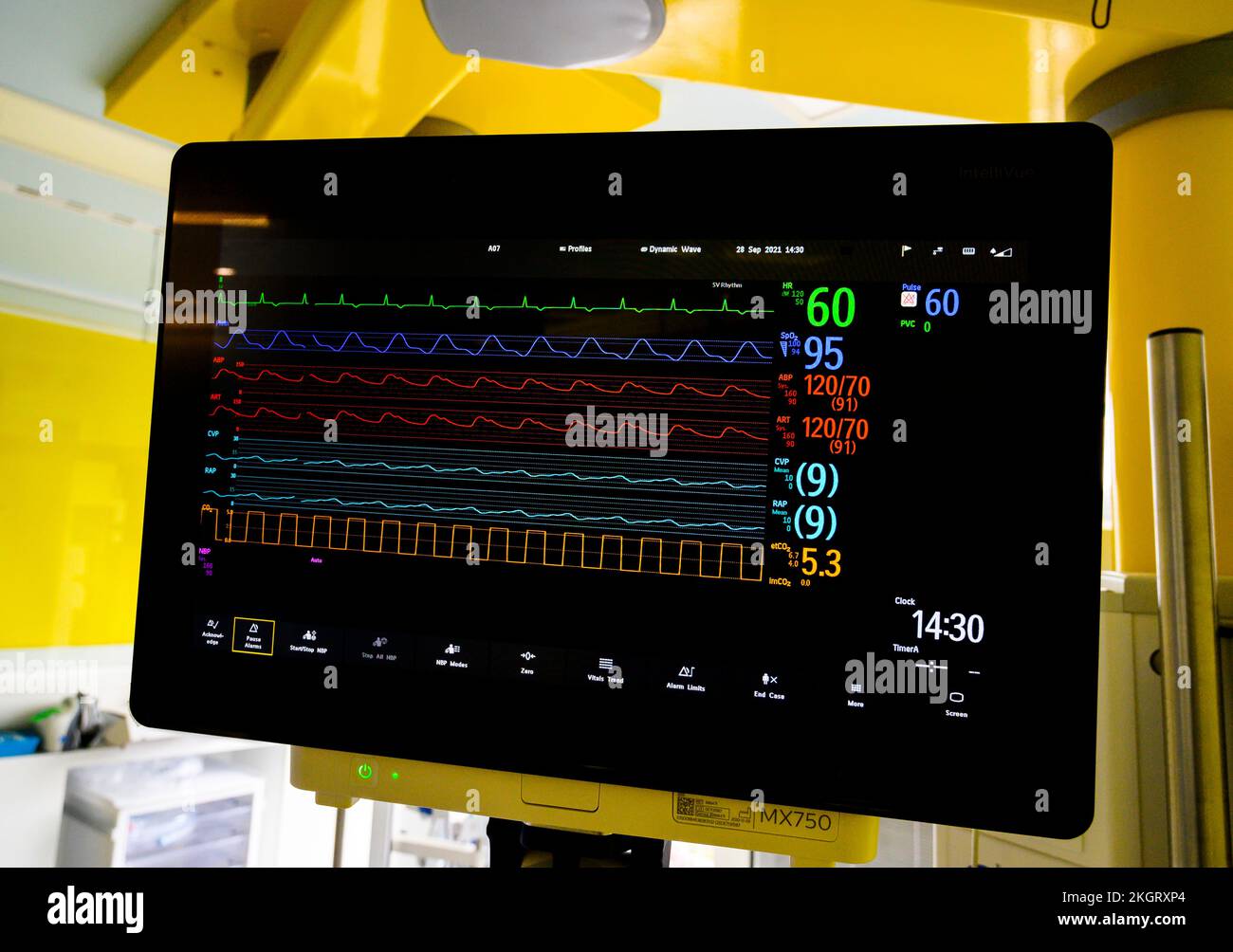 Anzeige eines bettseitigen Patientenmonitors in einem englischen Krankenhaus. Stockfoto
