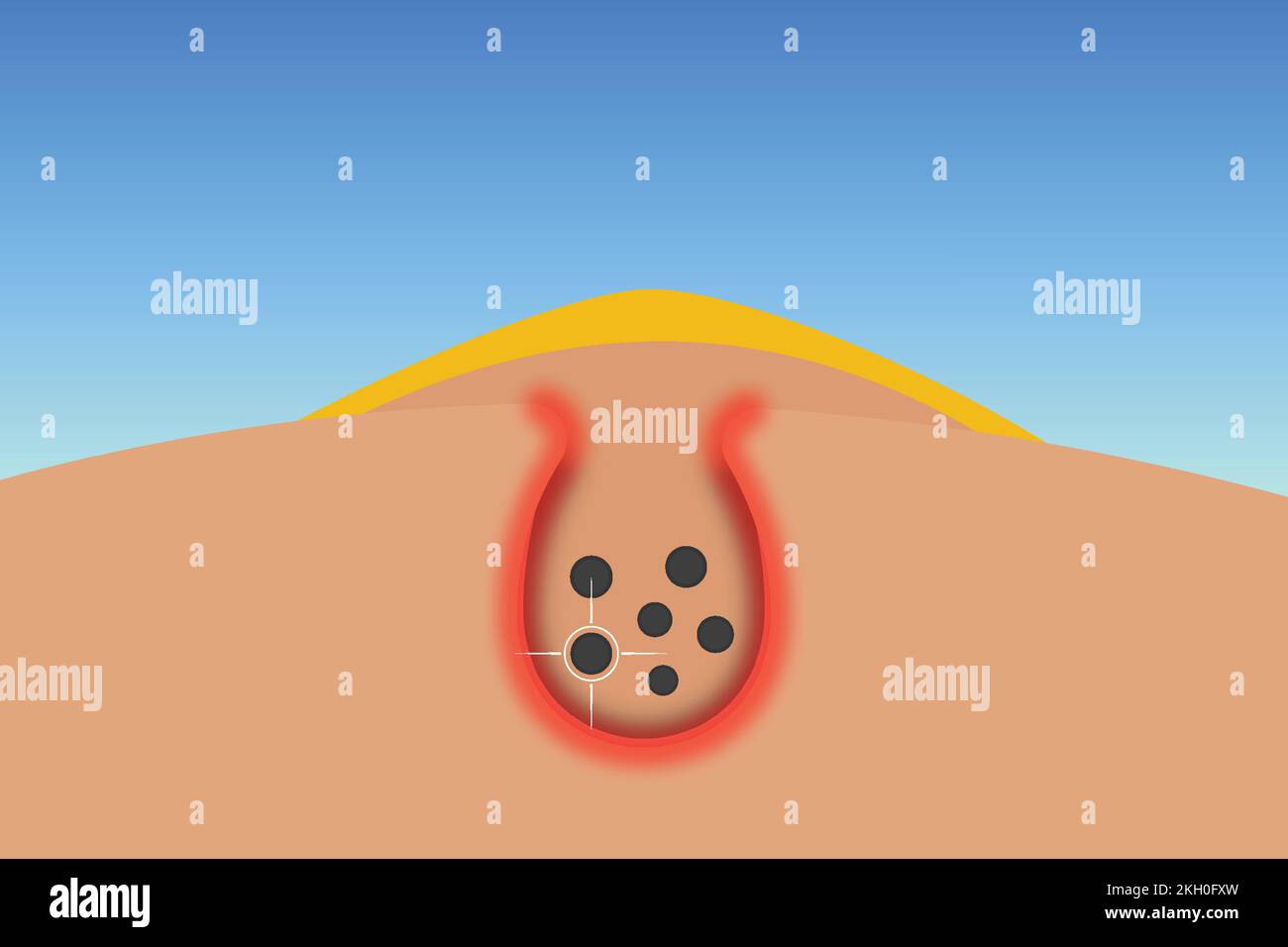 Abtötung von dunklen Flecken und Keimen unter der Haut. Entfernen von Schmutz und Keimen aus Akne der Haut mit Laser Concept Vector. Pickel mit Eiter, der wehtut und ein Re gibt Stock Vektor