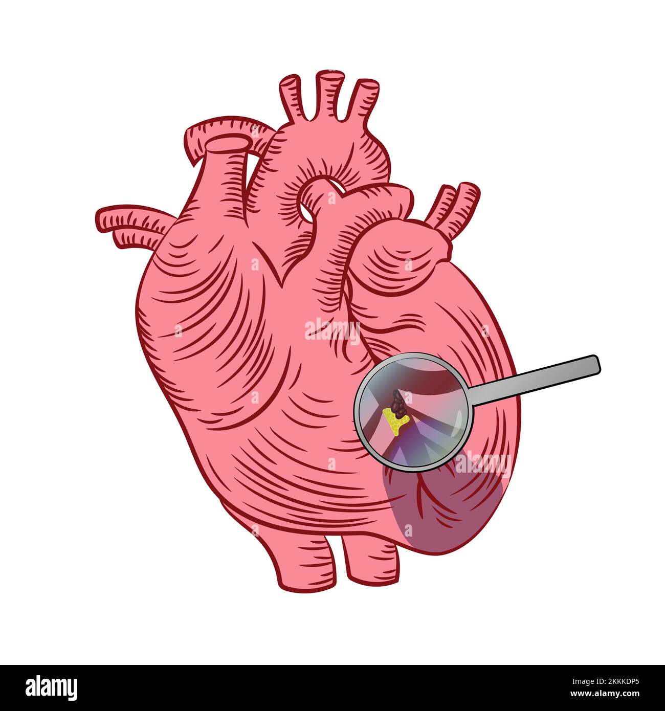 MYOKARDINFARKT Herzkrankheit Medizin Bildungsdiagramm Vektorschema menschlicher handgezeichneter Vektor Illustration Set zum Drucken Stock Vektor