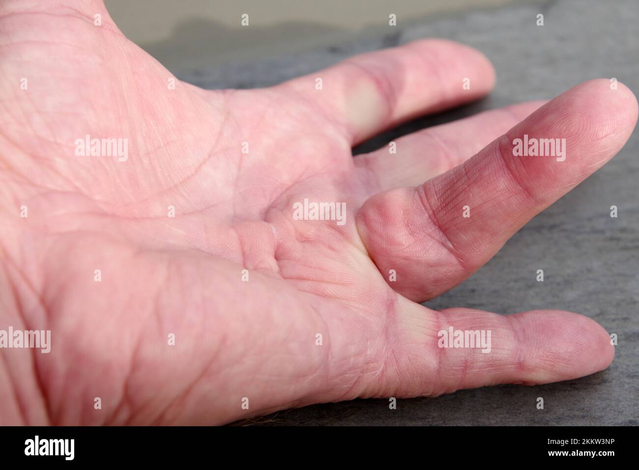 Schnappfinger (Tendovaginitis stenosans), Hand, Finger, ein Schnappfinger an der linken Hand Stockfoto