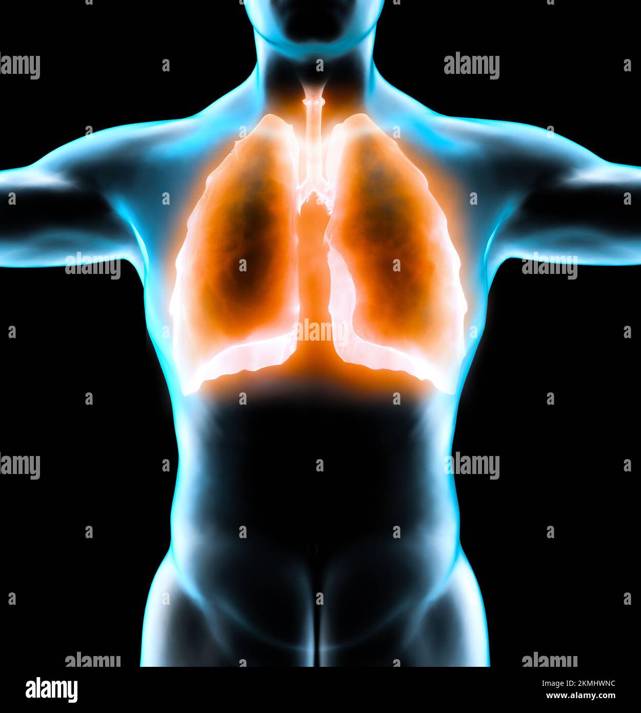 Menschliche Anatomie, Probleme mit dem Atmungssystem, schwer geschädigte Lungen. Bilaterale Pneumonie. Covid-19, Coronavirus. Patient und Rauch. Raucher Stockfoto