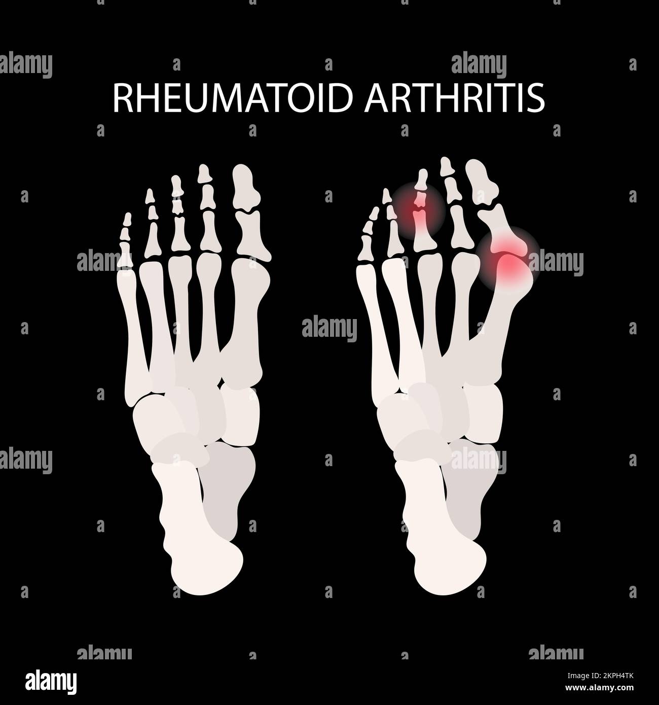 RHEUMATOIDE ARTHRITIS BEINFOKALE Läsionen der Beine chronische Erkrankung Medizin Bildungsdiagramm Vektorschema Handgezogener Clip Art Vector Illustration SE Stock Vektor