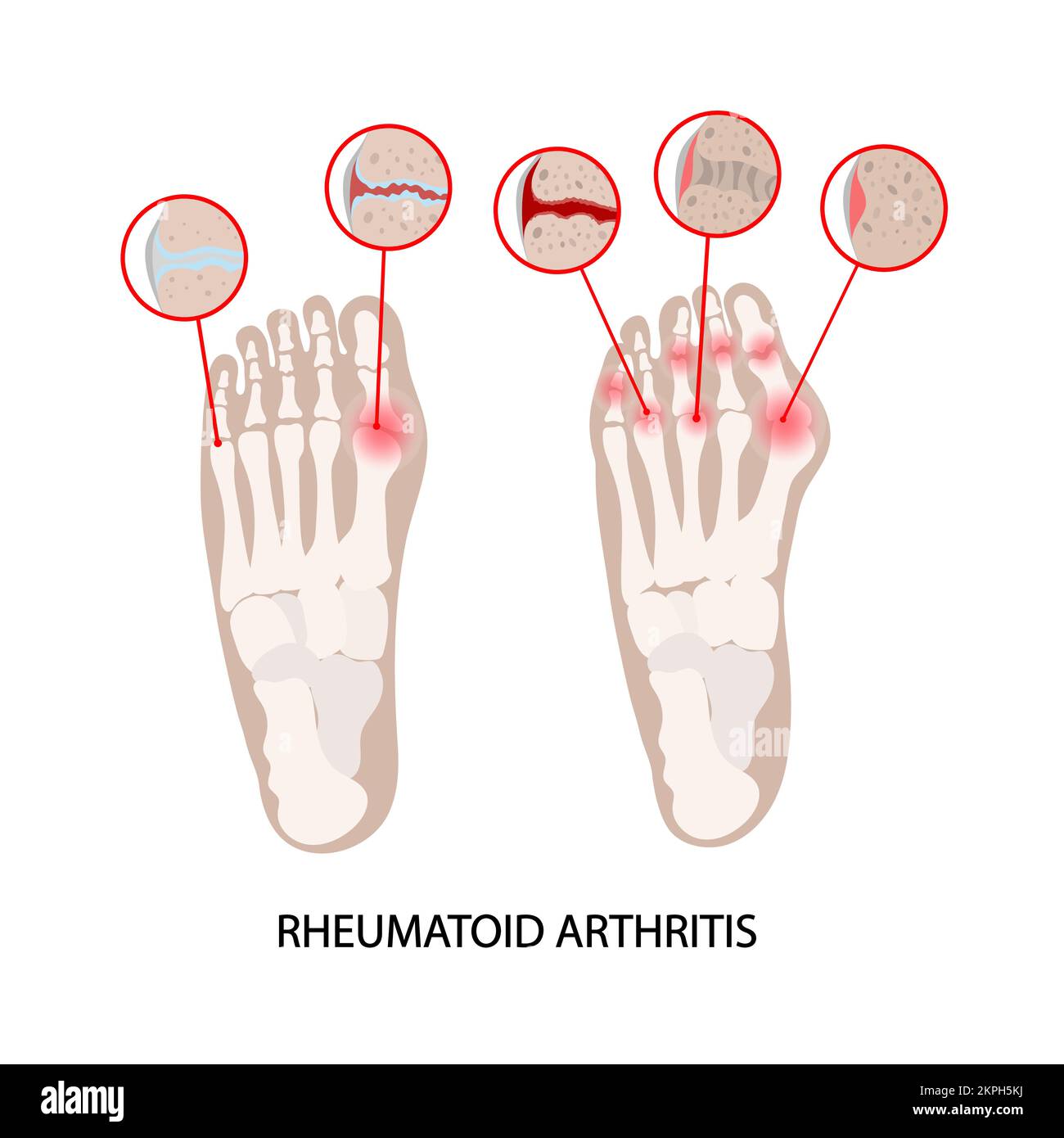 ARTHROSE BEI RHEUMATOIDER KRANKHEIT Diagramm der Läsionen menschlicher Beingelenke für die Maedizinische Schule Handgezogener Clip Art Vector Illustration Set für P Stock Vektor
