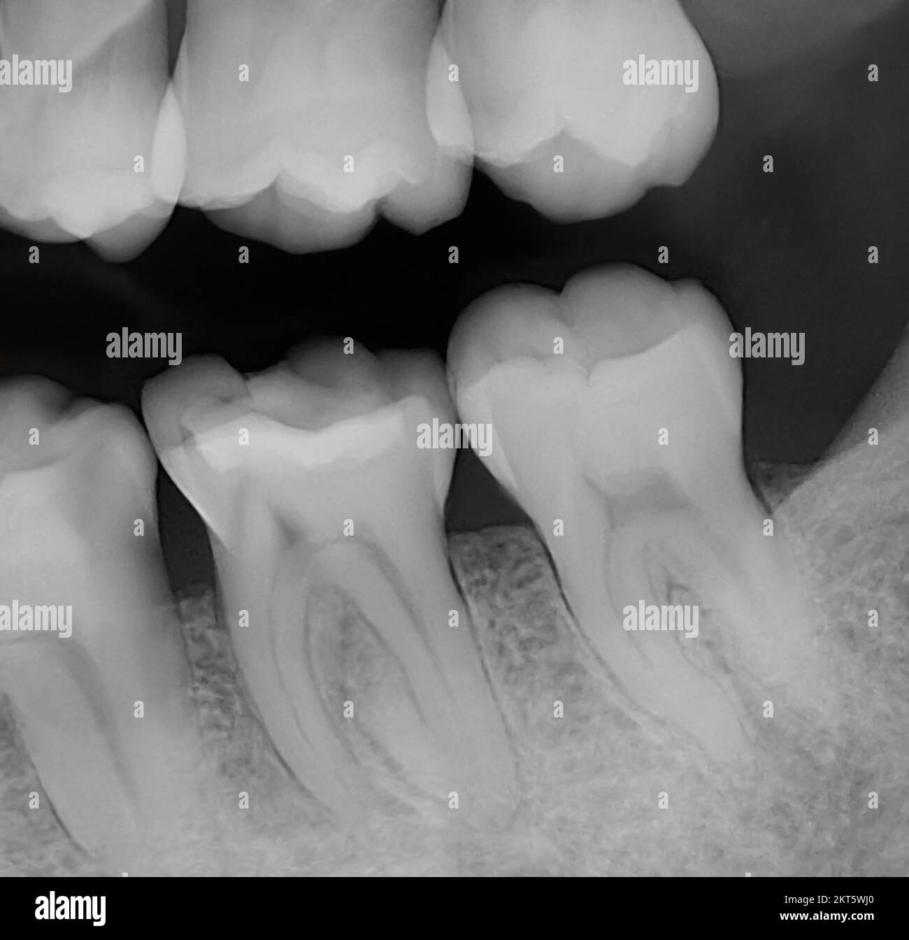 Backenzähne oben und unten rechts, Nummer 13,14,18,19 und 20. Ein Zahn mit einer Röntgenreihenaufnahme Stockfoto