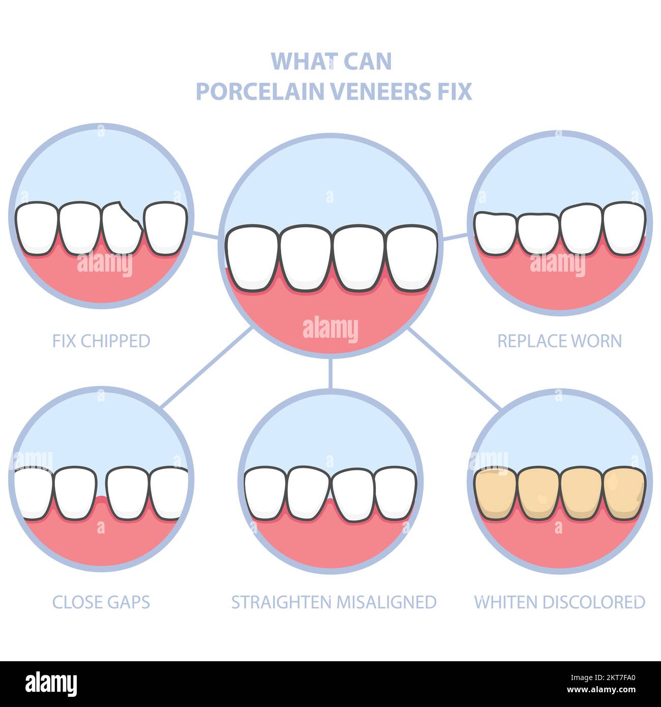 Verschönerung der Zähne und des Lächelns mit zahnärztlichen Keramikfurnier, Zahnreihe fixiert mit Furnier-Abdeckung, vor und nach Zähnen, Vektor Stock Vektor