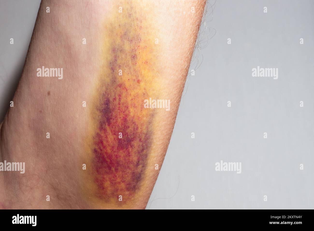 Ein großer farbiger Bluterguss auf der Innenseite der Schulter eines Mannes. Medizinisches Konzept. Stockfoto