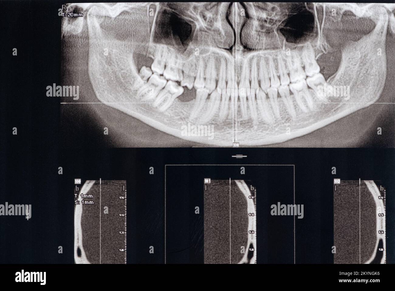 CT-Scan eines Patienten mit fehlendem Kauzahn und Fehlverschluss Stockfoto