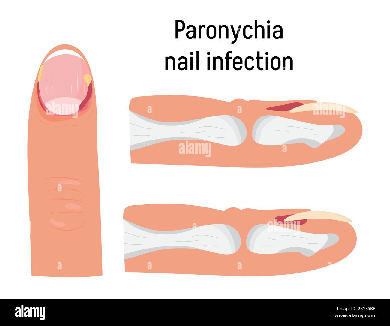 Paronychia konzepnt Vektor für medizinischen Blog, App, Banner. Nagelentzündung, die durch Trauma, Reizung oder Infektion hervorgerufen werden kann. Stock Vektor