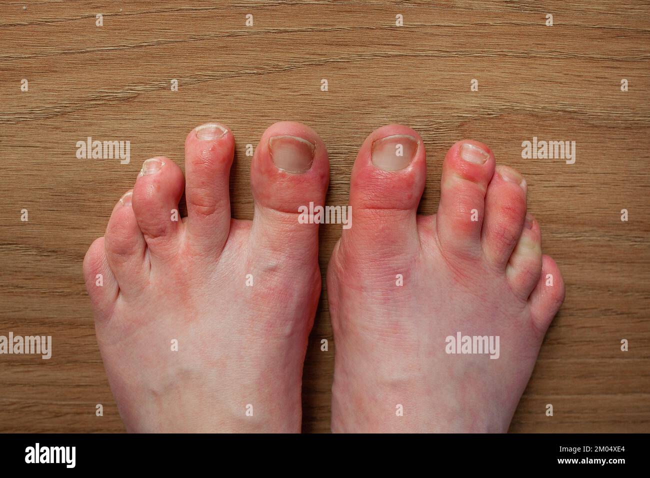 Füsse von Personen mit RaynaudPhänomen und Chilblainläsionen an Zehen Chilblains rot
