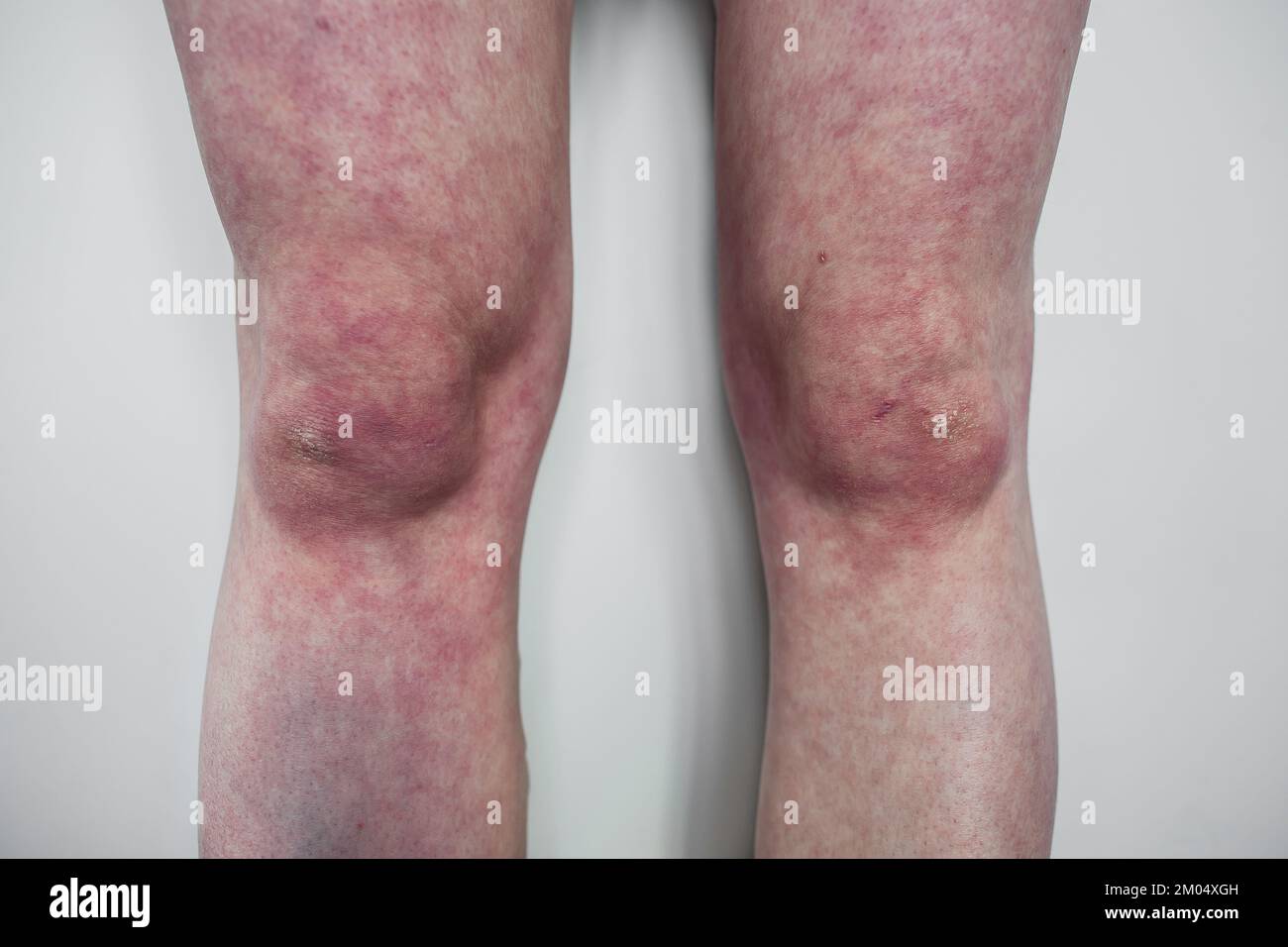 Beine des Menschen mit orthostatischem Intoleranzsyndrom Closeup Livedo reticularis mit trockener Haut Dysautonomia Purpurverfärbung der Beine beim Stehen Stockfoto
