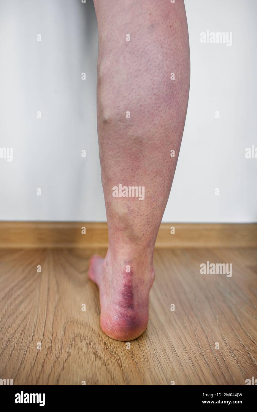 Bein mit Krampfadern Nahaufnahme einer stehenden Person mit Krampfadern im Bein mit verdrehten, ausbeulsten Venen, die unter der Haut sichtbar sind Rückansicht Stockfoto
