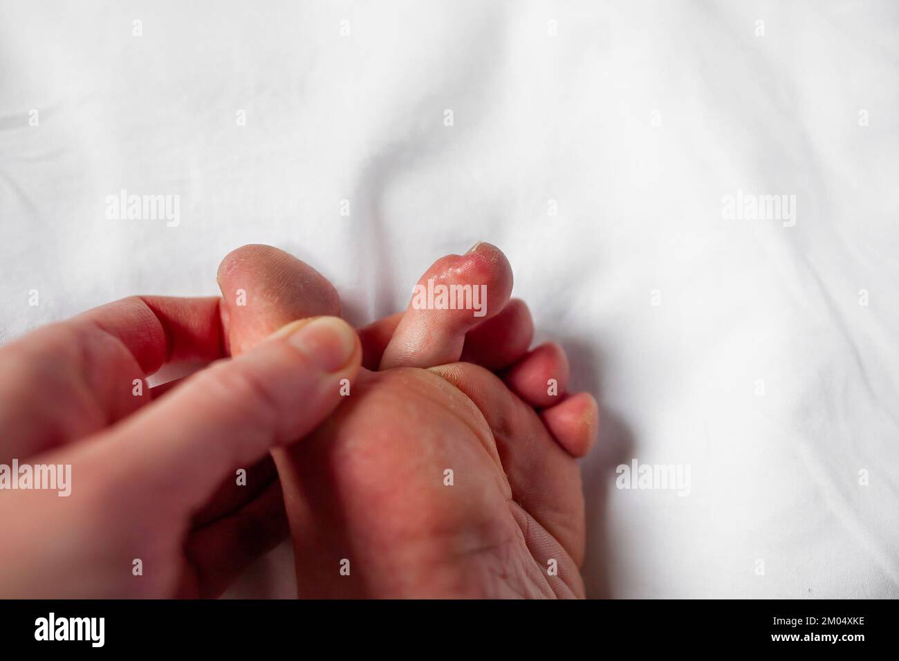 Chilblains an Zehen, rote juckende Unebenheiten, schwellender Fuss einer Person mit Raynaud-Phänomen und Chilblainläsionen Pernio-Dermatitis an den Fingern Perniosis Stockfoto