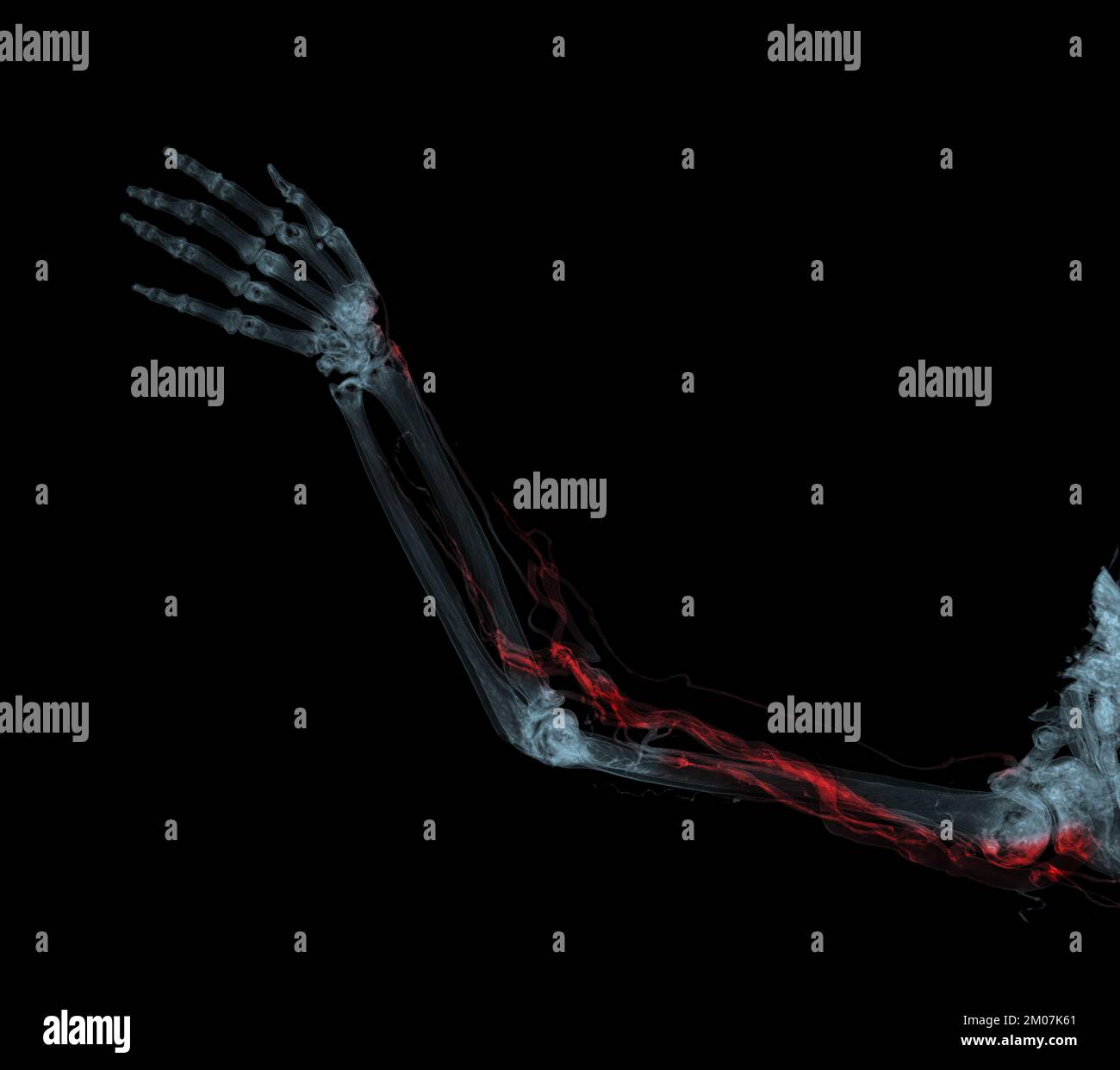 Armarterien mit Knochen-3D-Rendering der oberen Extremität vom CT-Scanner. Stockfoto