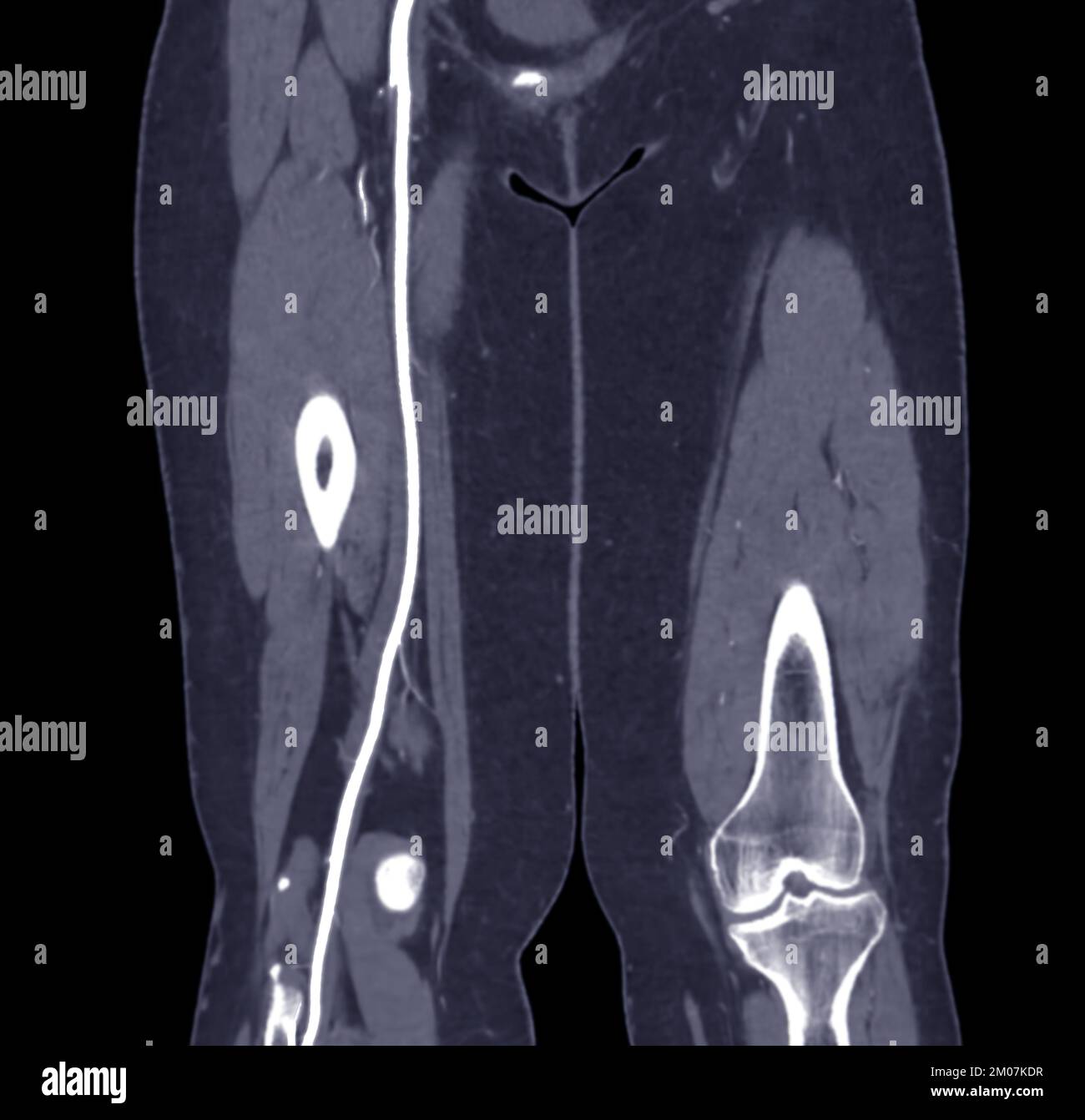 CTA der Arteria femoralis Abflussbild der Arteria femoralis für die Diagnose akuter oder chronischer peripherer arterieller Verschlusskrankheit. Stockfoto